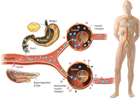 Diabetes_Koerper